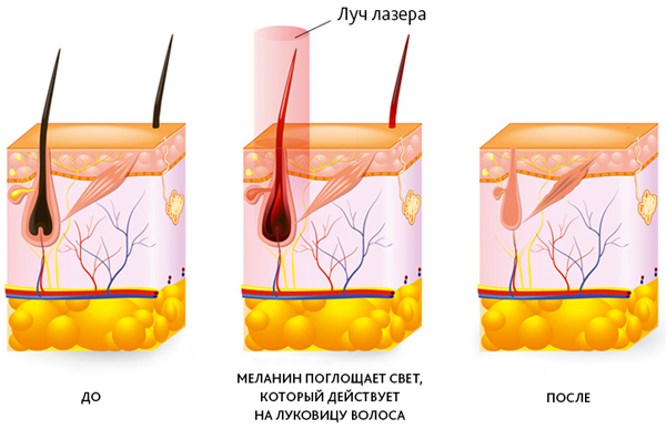 Лазерная эпиляция диодным лазером